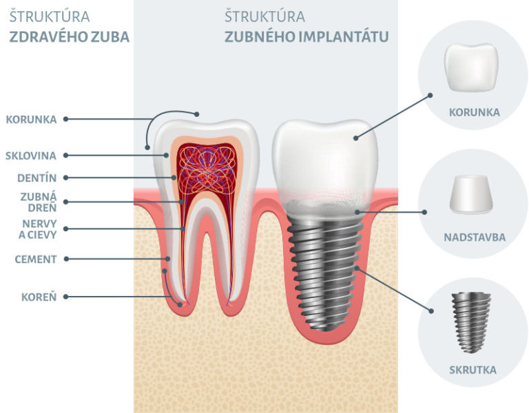 Prečo sú zubné implantáty tak výhodné?